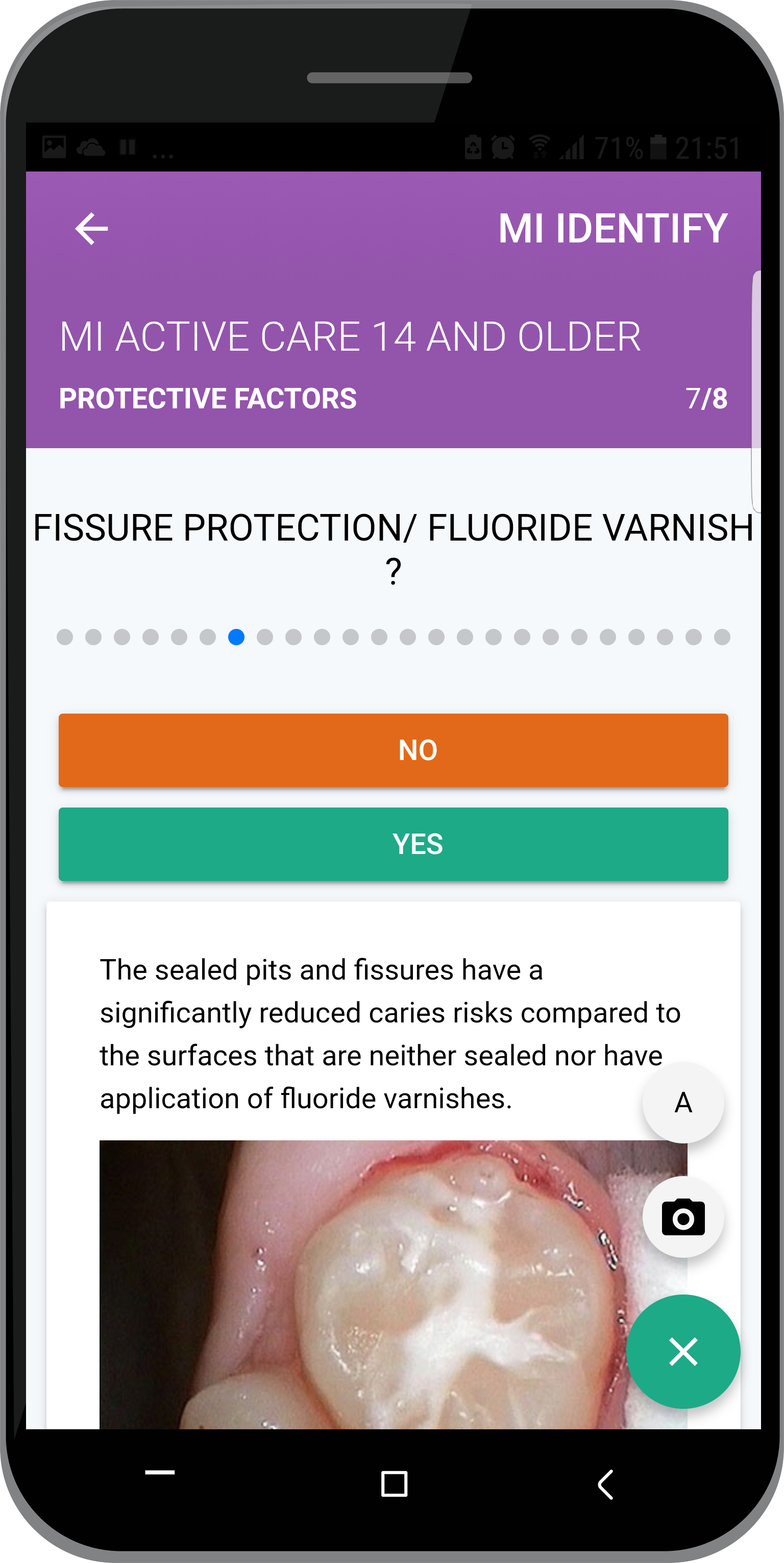 Fissure protection item CRA